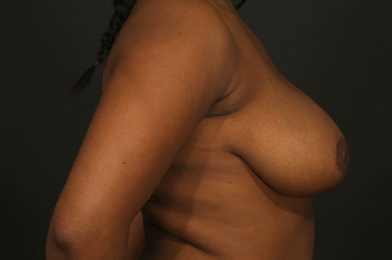 Breast Reduction Before & After Gallery - Patient 140123036 - Image 4