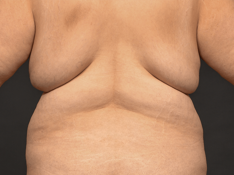 Back Lift Before & After Gallery - Patient 132579 - Image 1