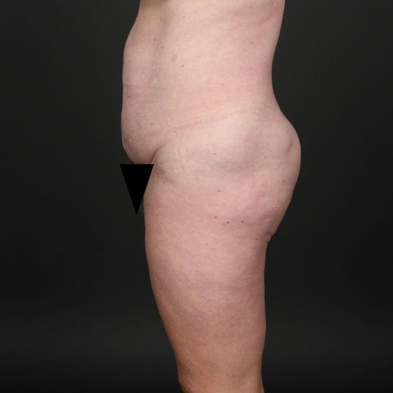 Tummy Tuck Before & After Gallery - Patient 302369 - Image 5