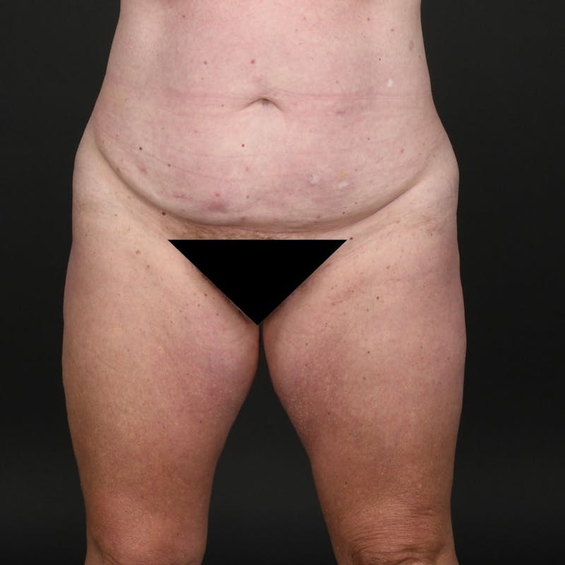 Tummy Tuck Before & After Gallery - Patient 302369 - Image 1