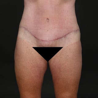 Tummy Tuck Before & After Gallery - Patient 302369 - Image 2