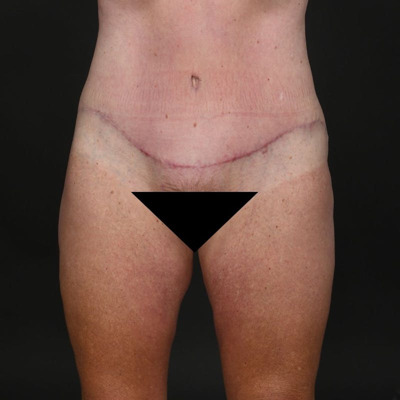 Tummy Tuck Before & After Gallery - Patient 302369 - Image 2