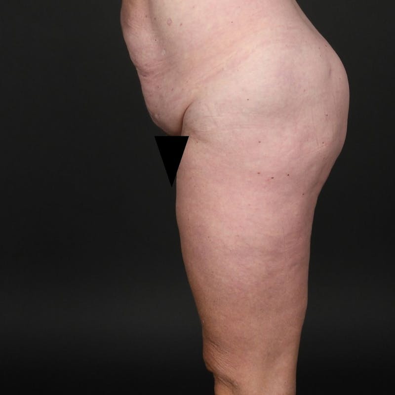 Tummy Tuck Before & After Gallery - Patient 302369 - Image 3