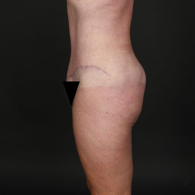 Tummy Tuck Before & After Gallery - Patient 302369 - Image 6