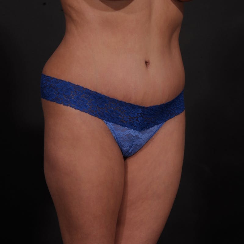 Tummy Tuck Before & After Gallery - Patient 280145 - Image 4
