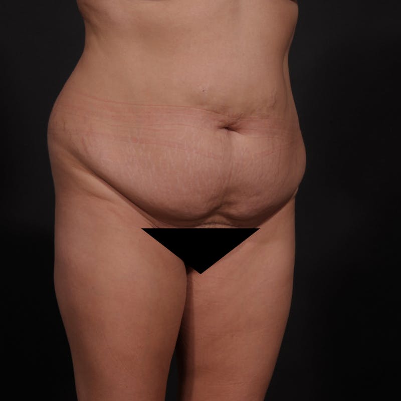 Tummy Tuck Before & After Gallery - Patient 280145 - Image 3