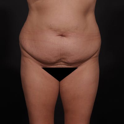 Tummy Tuck Before & After Gallery - Patient 280145 - Image 1