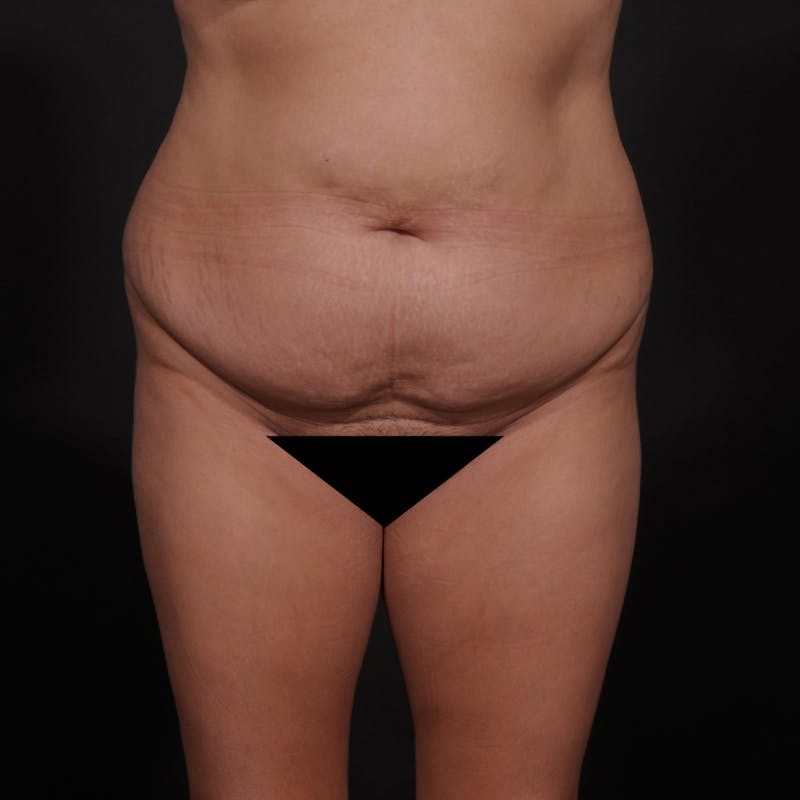 Tummy Tuck Before & After Gallery - Patient 280145 - Image 1