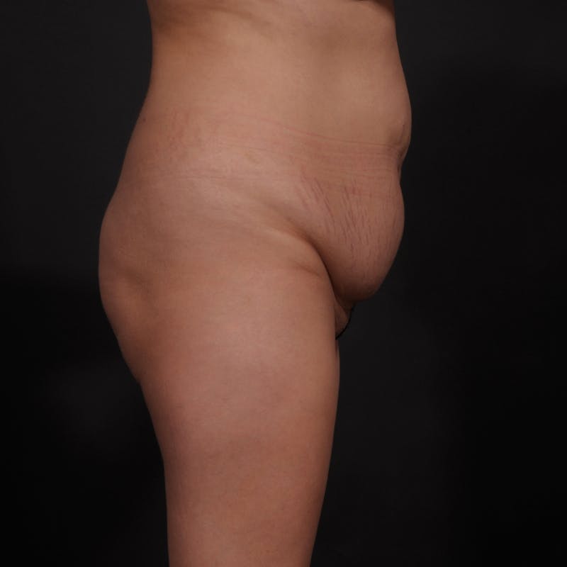 Tummy Tuck Before & After Gallery - Patient 280145 - Image 5