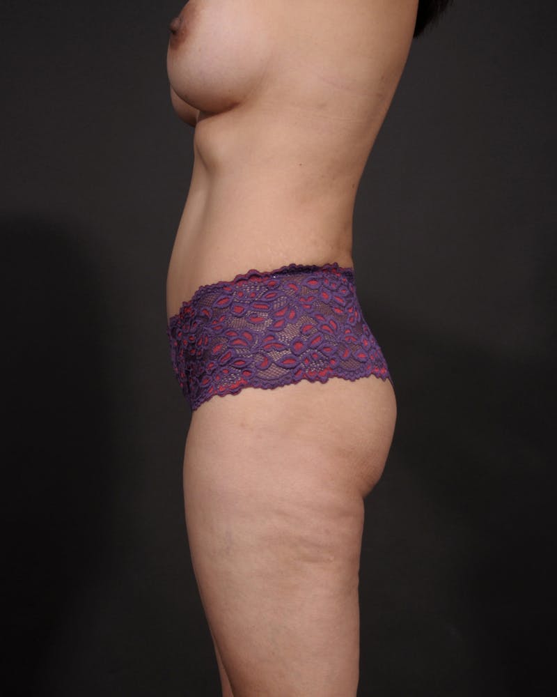 Mommy Makeover Before & After Gallery - Patient 363021 - Image 6