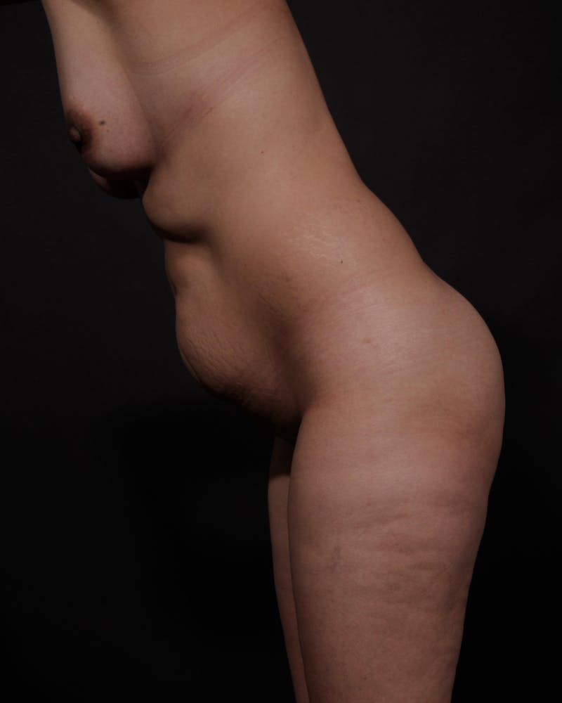 Mommy Makeover Before & After Gallery - Patient 363021 - Image 3