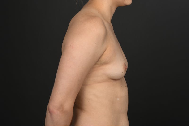 Breast Augmentation Before & After Gallery - Patient 111358 - Image 5