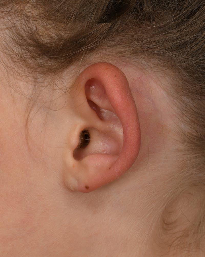 Ear Pinning Before & After Gallery - Patient 109912 - Image 5