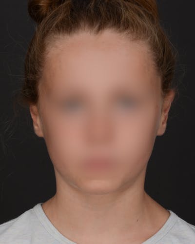 Ear Pinning Before & After Gallery - Patient 109912 - Image 2