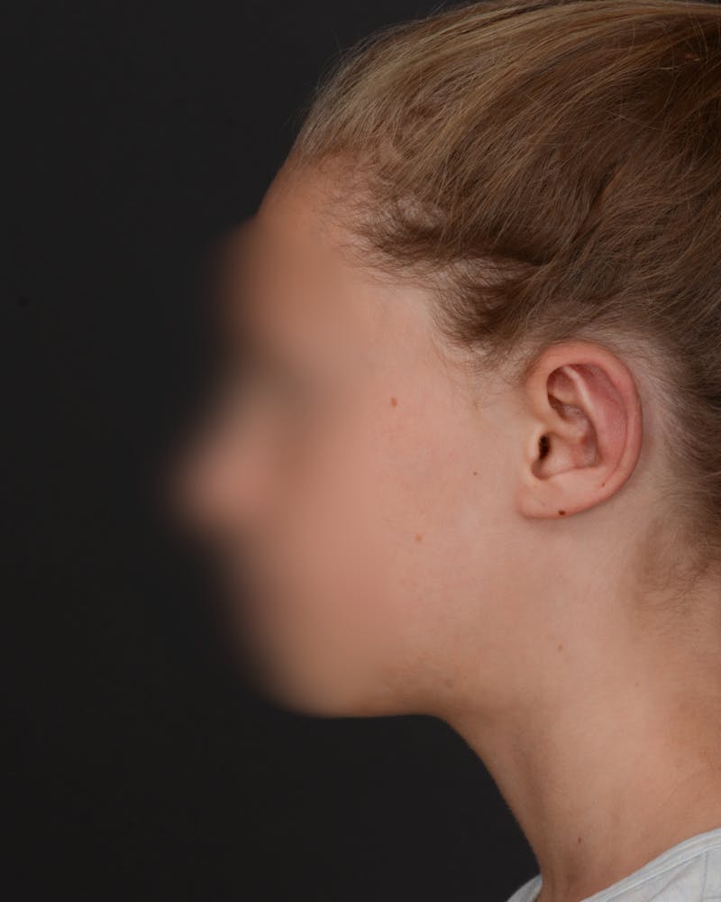Ear Pinning Before & After Gallery - Patient 109912 - Image 4