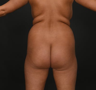 Liposuction Before & After Gallery - Patient 297358 - Image 1