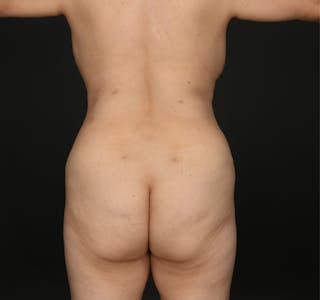 Liposuction Before & After Gallery - Patient 245853 - Image 6