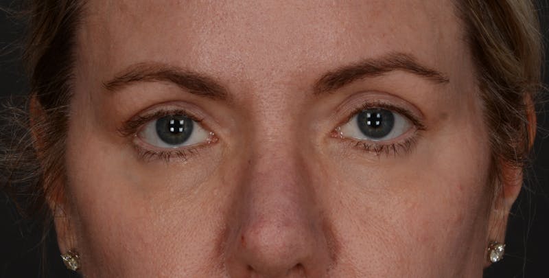 Blepharoplasty Before & After Gallery - Patient 176796 - Image 2