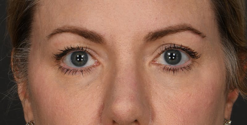Blepharoplasty Before & After Gallery - Patient 176796 - Image 1