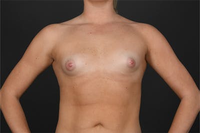 Breast Augmentation Before & After Gallery - Patient 827925 - Image 1