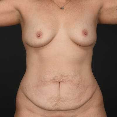 Tummy Tuck Before & After Gallery - Patient 368754 - Image 1