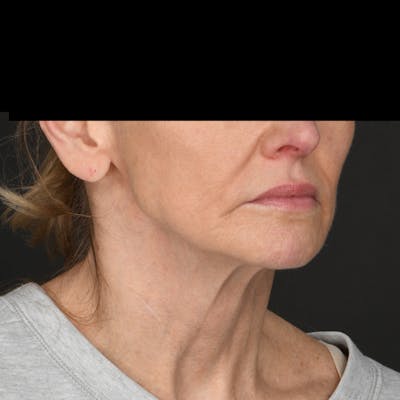 Neck Lift Before & After Gallery - Patient 214316 - Image 1