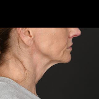 Neck Lift Before & After Gallery - Patient 214316 - Image 4