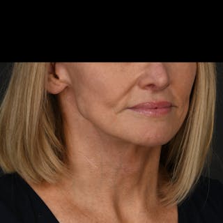 Neck Lift Before & After Gallery - Patient 214316 - Image 2