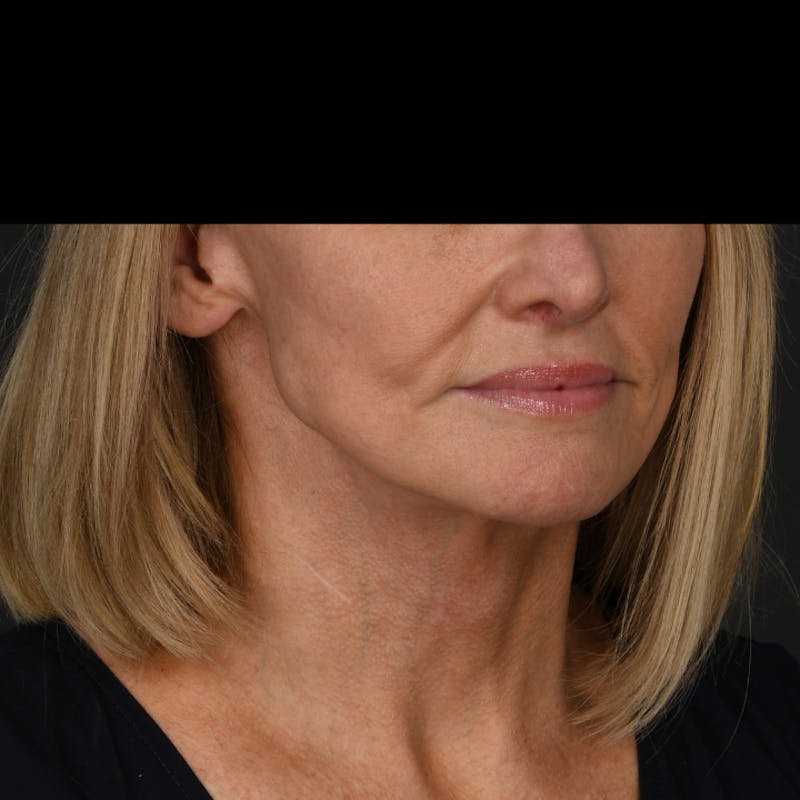 Neck Lift Before & After Gallery - Patient 214316 - Image 2