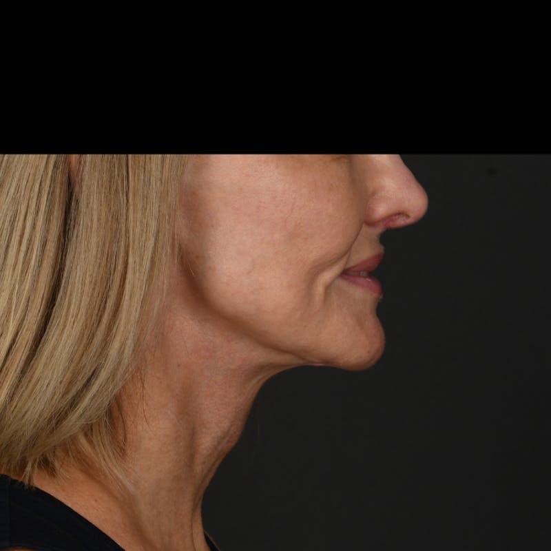 Neck Lift Before & After Gallery - Patient 214316 - Image 3