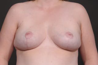 Breast Lift Before & After Gallery - Patient 261897 - Image 2