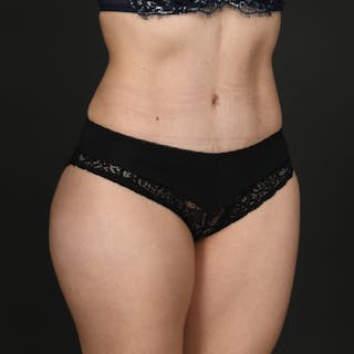 Tummy Tuck Before & After Gallery - Patient 187410 - Image 4