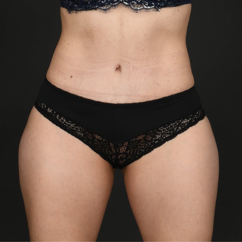 Tummy Tuck Before & After Gallery - Patient 187410 - Image 2
