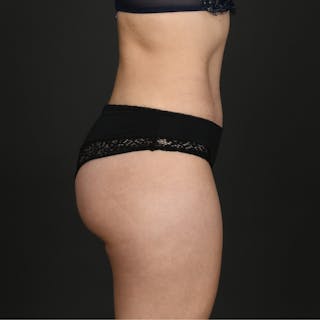 Tummy Tuck Before & After Gallery - Patient 187410 - Image 8