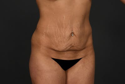 Tummy Tuck Before & After Gallery - Patient 306546 - Image 1