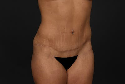Tummy Tuck Before & After Gallery - Patient 306546 - Image 2