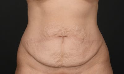 Tummy Tuck Before & After Gallery - Patient 368754 - Image 1