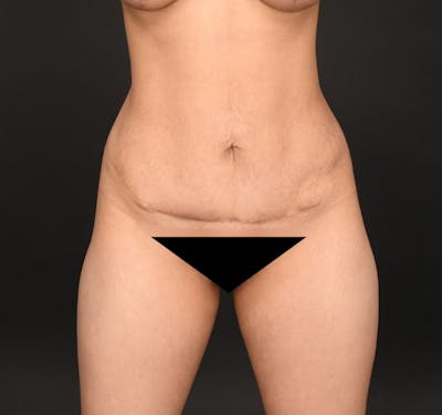 Tummy Tuck Before & After Gallery - Patient 297732 - Image 1