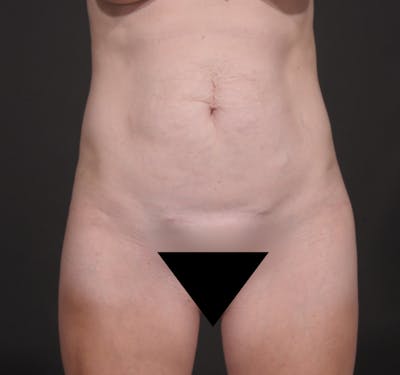 Tummy Tuck Before & After Gallery - Patient 503217 - Image 1