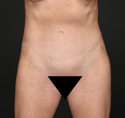 Tummy Tuck Before & After Gallery - Patient 503217 - Image 2