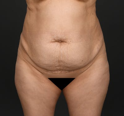 Tummy Tuck Before & After Gallery - Patient 290671 - Image 1