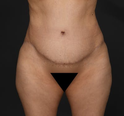 Tummy Tuck Before & After Gallery - Patient 290671 - Image 2