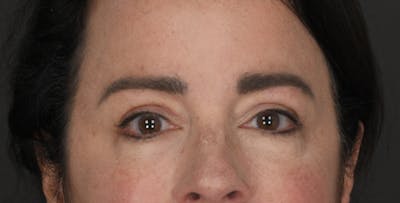 Blepharoplasty Before & After Gallery - Patient 344256 - Image 2