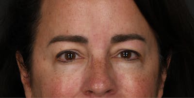 Blepharoplasty Before & After Gallery - Patient 344256 - Image 1