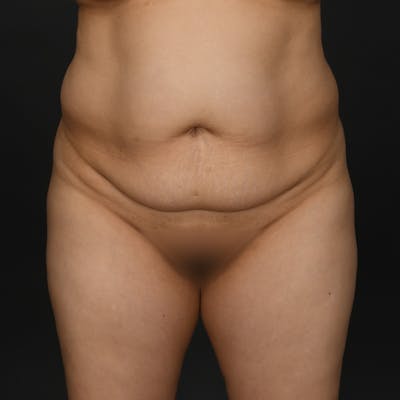 Tummy Tuck Before & After Gallery - Patient 279049 - Image 1