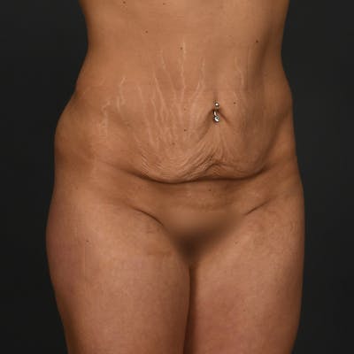 Tummy Tuck Before & After Gallery - Patient 306546 - Image 1