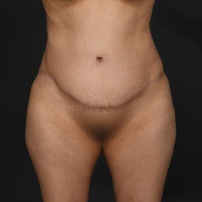 Tummy Tuck Before & After Gallery - Patient 290671 - Image 2