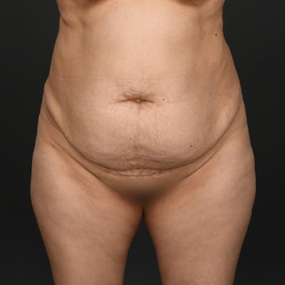 Tummy Tuck Before & After Gallery - Patient 290671 - Image 1