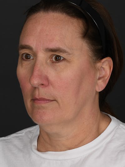 Composite Facelift Before & After Gallery - Patient 218355 - Image 1