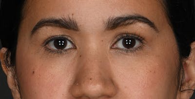 Blepharoplasty Before & After Gallery - Patient 227075 - Image 1